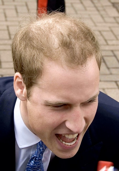 is prince william balding. Prince William Bald?